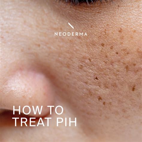 treat pih treatment  natural skin care products neoderma