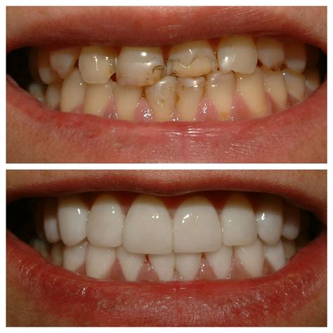 List 91+ Pictures Before And After Pictures Of Invisalign Completed