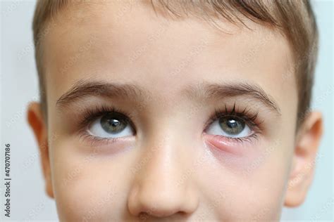 Stye, hordeolum, bacterial infection of oil gland in eyelid. Red tender ...