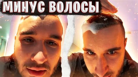КОРЕШ ПРО%БАЛ ОПЕРАЦИЮ НА ВОЛОСЫ / ПОСЛЕ ОПЕРАЦИИ, Пересадка Волос ...