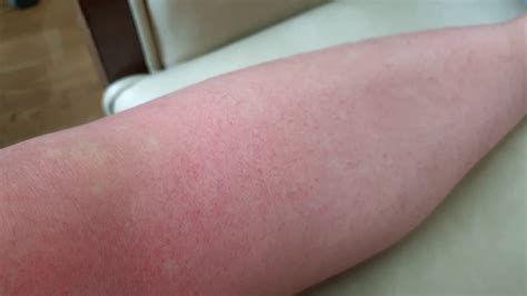 dengue fever red spots pox rash  patient stock footage sbv