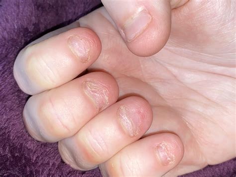 Is this normal? Tips of my nails are extremely white. Is this a