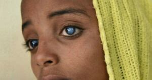 Blue Dot Cataract: Meaning, Symptoms, Causes And Treatment