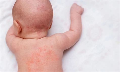 elevated serum total ige   eczema exacerbation  kids