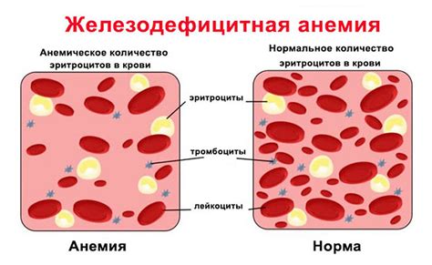 Железодефицитная анемия — МОСГОРМЕД – запись к врачам в Москве