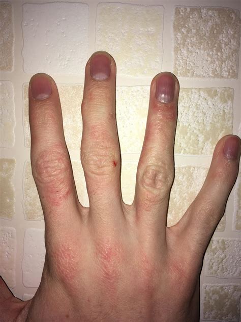 How does one get rid of eczema / dry skin on hands? : r/eczema