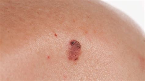 Ploščatocelični karcinom kože - DERMATOLOŠKI CENTER DERM