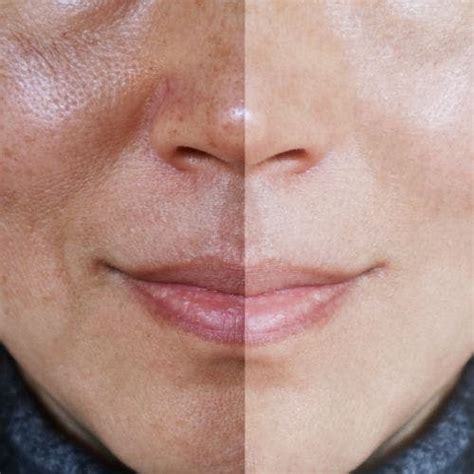Sun Spot Removal: Helpful Methods to Try | Experts Explain