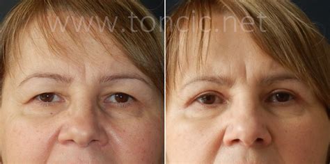 Blefaroplastika | Poliklinika dr. Tončić