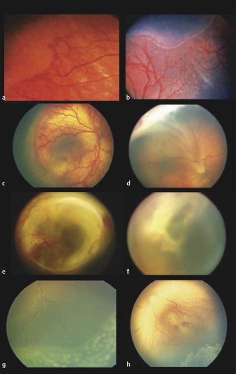 retinopathy  prematurity ento key