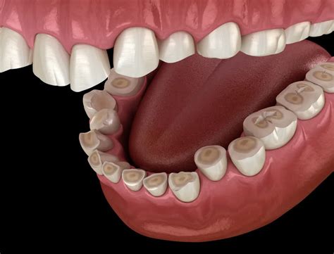 Bruxism Treatment: A Comprehensive Guide to Teeth Grinding | Arizona ...