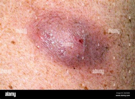 Skin Cyst On Back