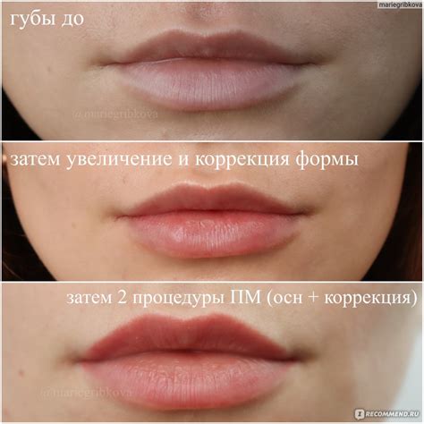 Филлер для губ Juvederm Ultra Smile - «Заезженный Juvederm Ultra Smile ...