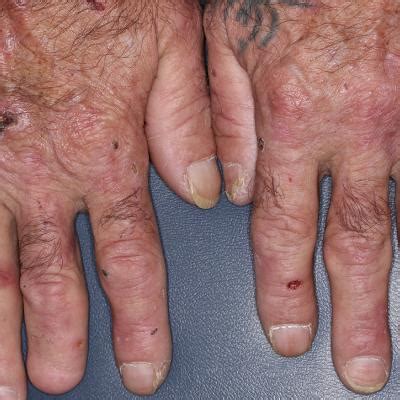 Chronic blistering rash on hands | MDedge Family Medicine