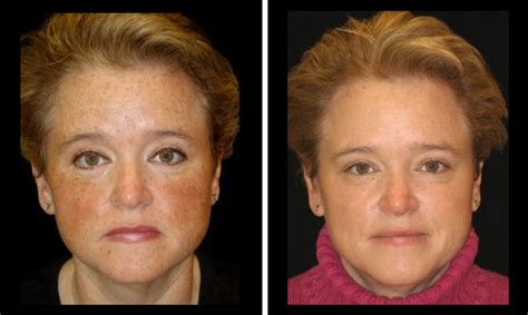 BBL Laser Treatment for Rosacea