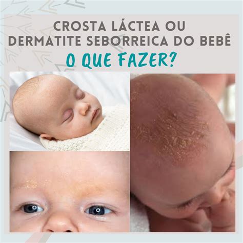 O Que Causa Dermatite Em Bebe - Dermatite Seborreica Bebê