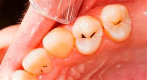 Лечение кариеса зубов в Томске недорого – стоматология «Dentalika»