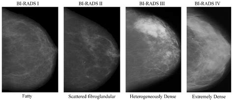 TwoViewDensityNet: Two-View Mammographic Breast Density Classification