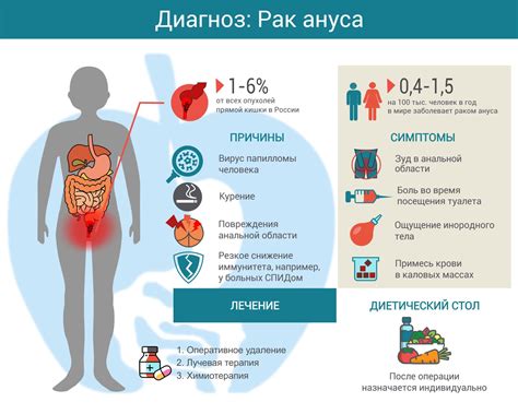 Рак ануса – причины, стадии опухоли, симптомы, методы лечения