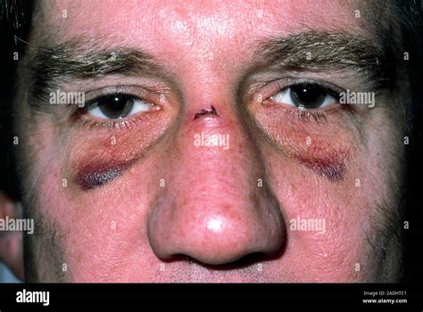how to know if nose is fractured