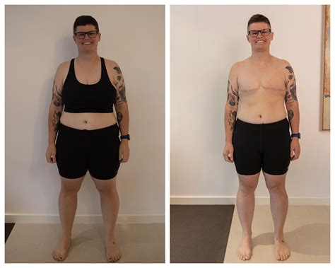 Cis woman, before and after top surgery : r/TopSurgery