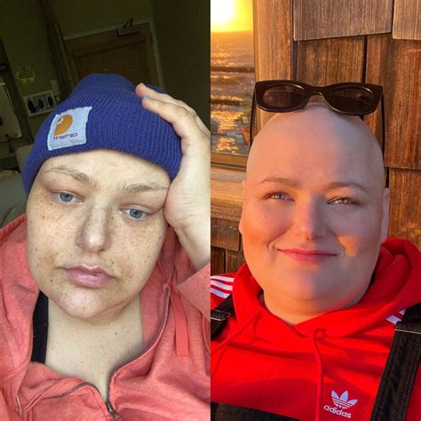 My face during my bone marrow transplants six months ago vs now. No