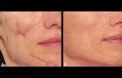 scars removal surgery cost renew physical therapy
