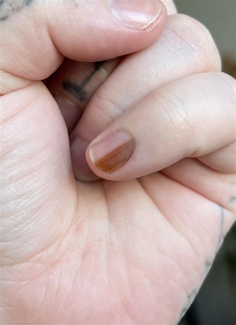 Nail matrix biopsy experience : r/DermatologyQuestions