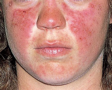 lupus  overheating  symptoms    stay cool lupus