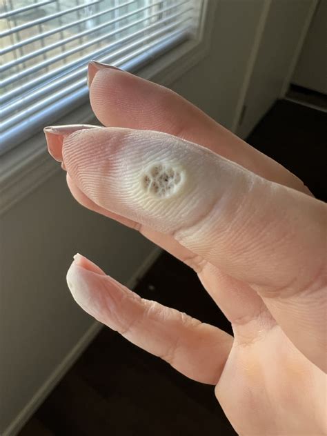 GF’s wart after 4 days of medicated bandages, is it ready to file down