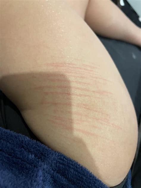 Sh scars, almost 1 and 1/2 years old : r/SelfHarmScars