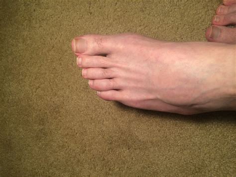 Bursitis fifth metatarsal base, "peroneal tendon strain" : r/Podiatry