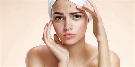 rid  red marks  acne red pimples marks