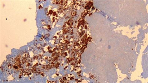 victorian department  health issues alert   fever disease news