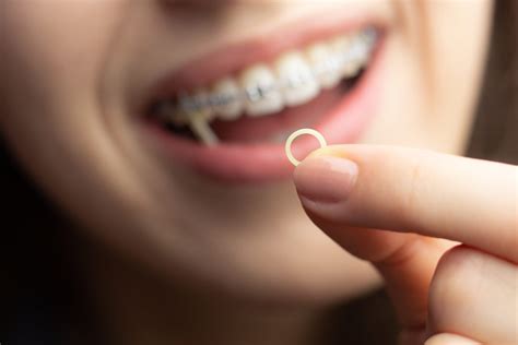 Orthodontic Elastics: Are They For You? | American Association of ...