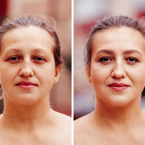 Natural Fillers 101: Enhancing Beauty the Natural Way ...