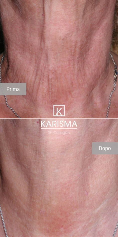 KARISMA - Softfiller biorestitutivo | Rh Collagen