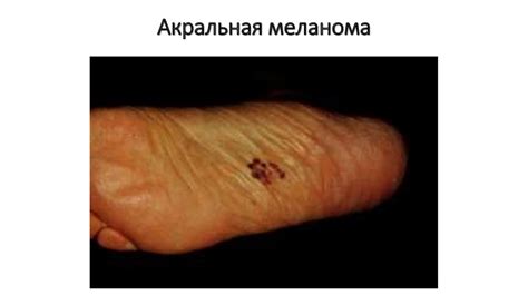 Клиническая, морфологическая и молекулярная диагностика меланомы ...