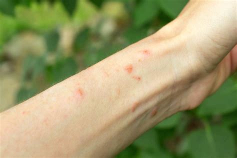Poison Ivy Rash: Pictures, What to Do, and Prevention