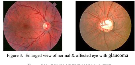 Figure 1 from Investigation of primary glaucoma by CDR in fundus images ...