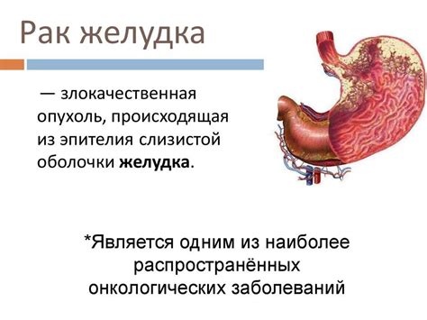 Рак желудка женщин: симптомы, первые признаки, причины