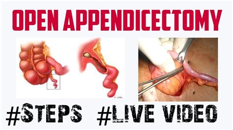 Open Appendicectomy-operative steps - YouTube