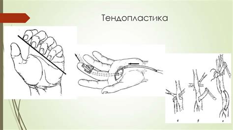 Повреждения сгибателей пальцев кисти - презентация онлайн