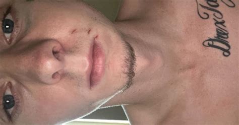 5 Warning Signs Your Jaw Might Be Fractured