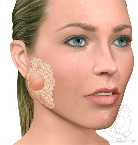 Tumor De La Glándula Parótida