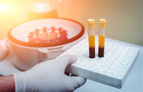 Technical Procedures For Preparation Of PRP In NJ – bumpsandjumpsrc