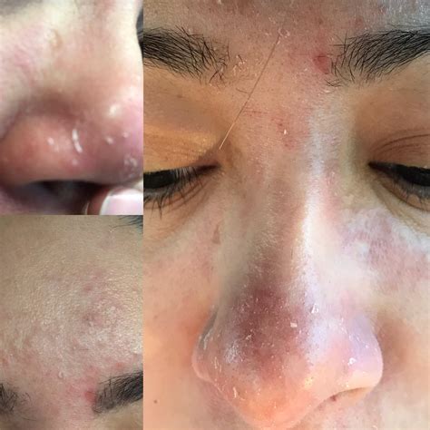 How To Get Rid Of Dry Flaky Skin On Side Of Nose at Rita Skelley blog