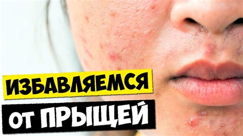 Как избавиться от прыщей / Очищающая маска для лица - YouTube