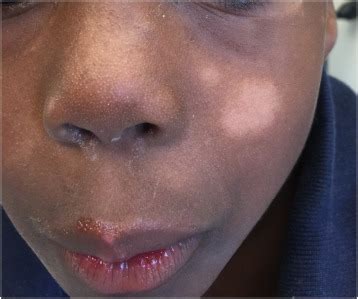 The color of skin: white diseases of the skin, nails, and mucosa ...