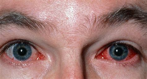 Diseases Of The Eye
